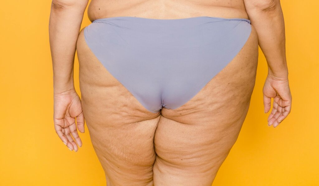 Nutrizionista a Verona spiega dieta e strategie scientifiche per migliorare la cellulite e la ritenzione idrica