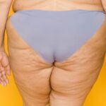 Nutrizionista a Verona spiega dieta e strategie scientifiche per migliorare la cellulite e la ritenzione idrica